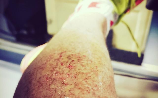 Jonty Rhodes injured leg