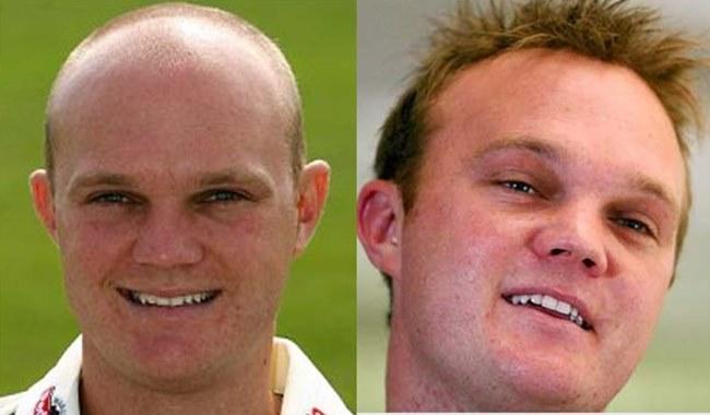 Cricketers who went for a hair transplant